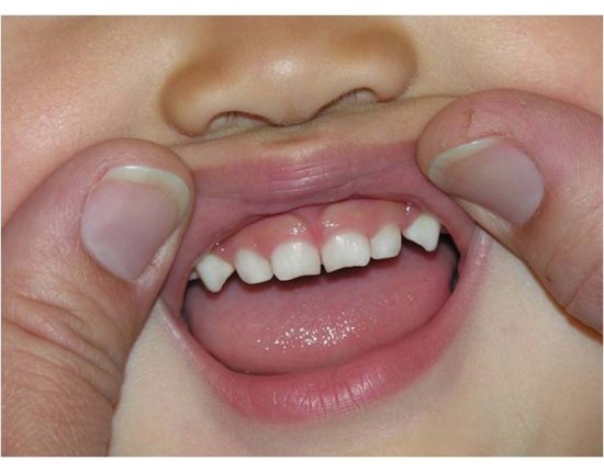 Прорезывание зубов у детей фото