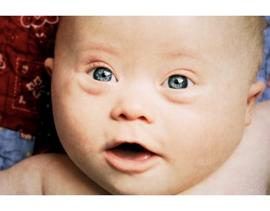 Фотографии новорожденных детей с синдромом дауна