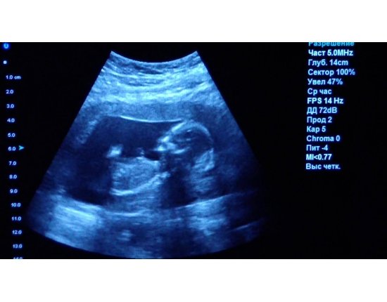 Ребенок в 20 недель беременности фото узи