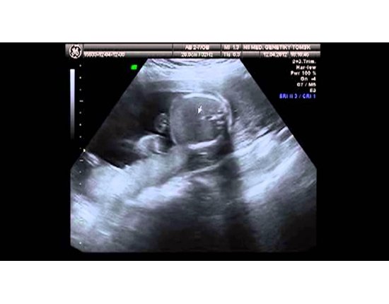Ребенок в 20 недель беременности фото узи
